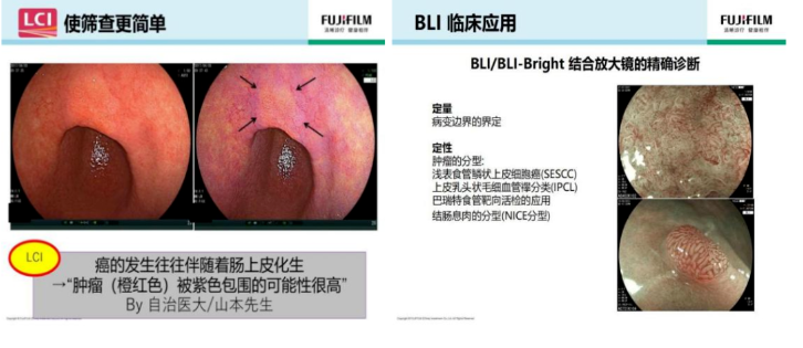 进口胃镜都有哪些品牌内镜中的“福尔摩斯”——日本富士ELUXEO 7000高清电子胃肠镜！_https://www.jmylbn.com_新闻资讯_第13张