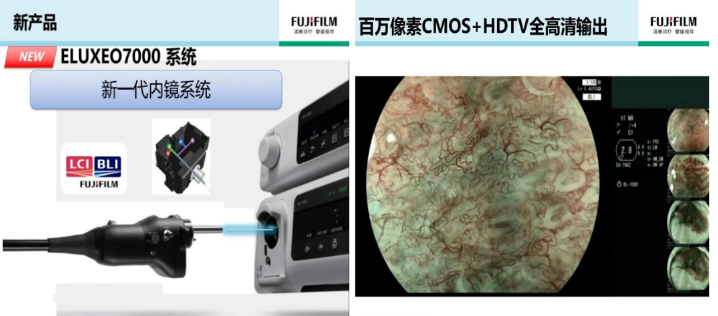 进口胃镜都有哪些品牌内镜中的“福尔摩斯”——日本富士ELUXEO 7000高清电子胃肠镜！_https://www.jmylbn.com_新闻资讯_第12张
