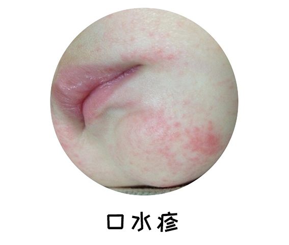 宝宝反复湿疹 痱子 淹脖子 都与这个问题有关 育儿经验 育儿知识 母婴育儿知识 育儿达人 微信头条新闻公众号文章收集网
