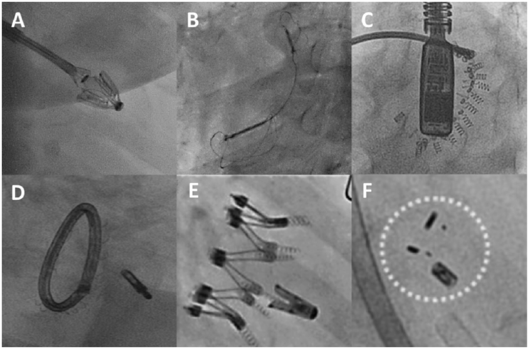 ero为什么不显示经导管二尖瓣修复术：相关病理生理学、研究和治疗综述_https://www.jmylbn.com_新闻资讯_第12张