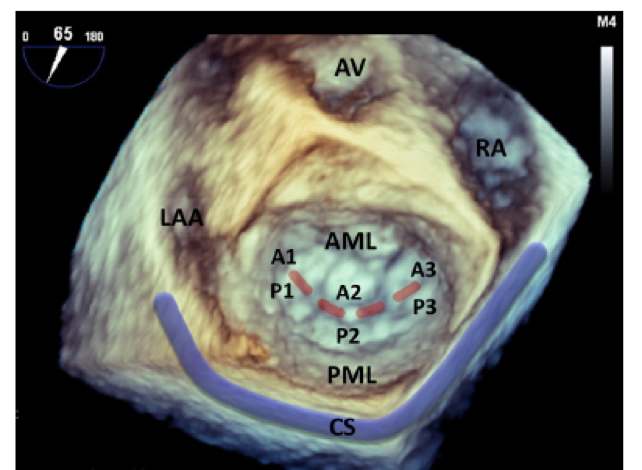 ero为什么不显示经导管二尖瓣修复术：相关病理生理学、研究和治疗综述_https://www.jmylbn.com_新闻资讯_第1张