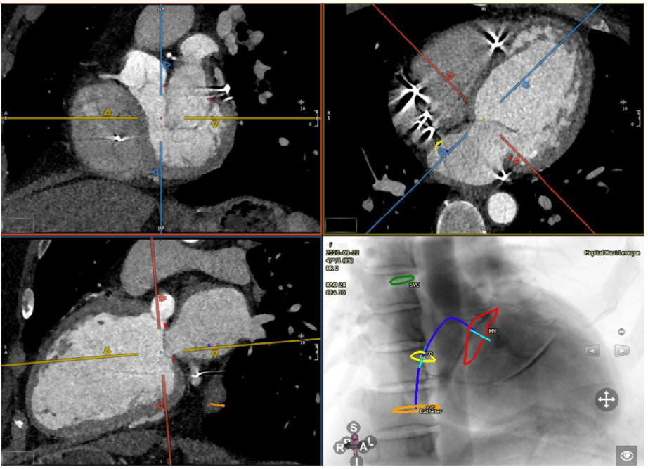 ero为什么不显示经导管二尖瓣修复术：相关病理生理学、研究和治疗综述_https://www.jmylbn.com_新闻资讯_第4张