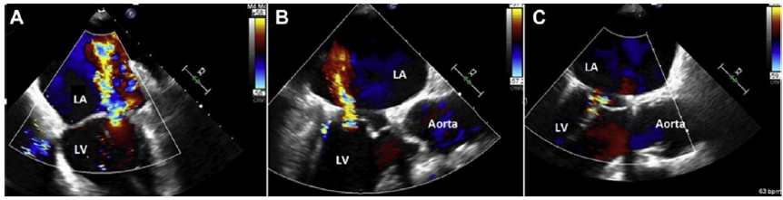 ero为什么不显示经导管二尖瓣修复术：相关病理生理学、研究和治疗综述_https://www.jmylbn.com_新闻资讯_第10张