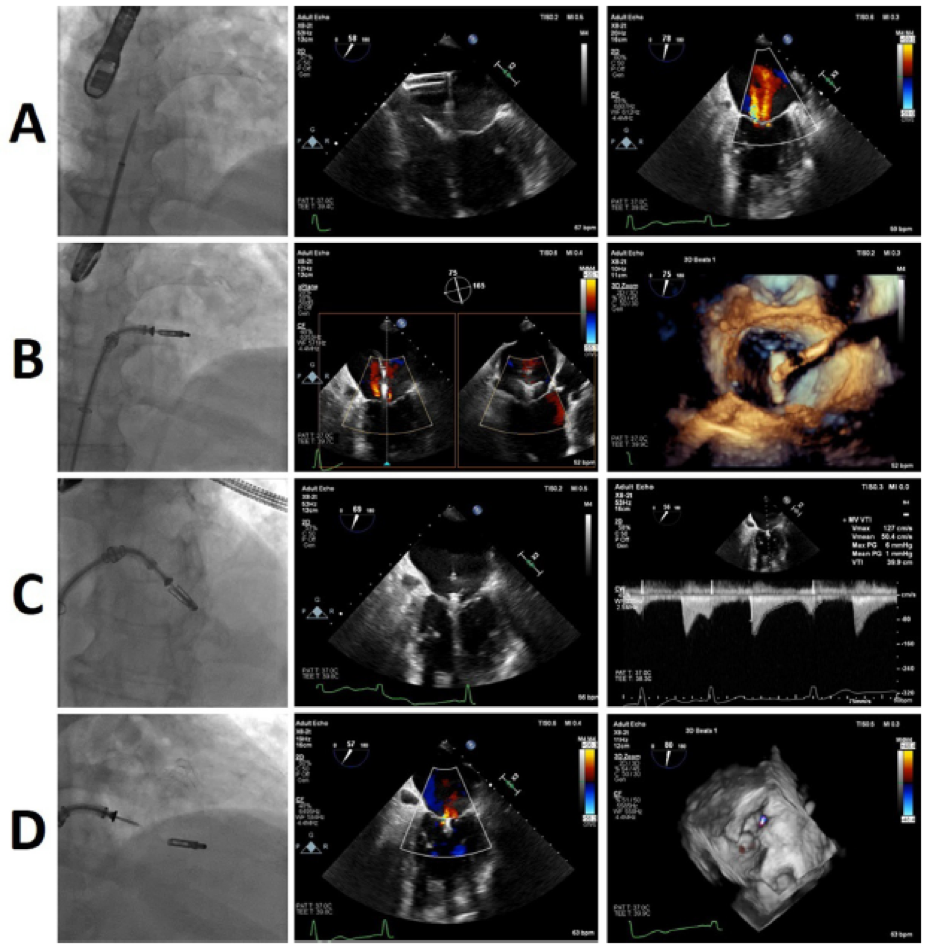 ero为什么不显示经导管二尖瓣修复术：相关病理生理学、研究和治疗综述_https://www.jmylbn.com_新闻资讯_第8张
