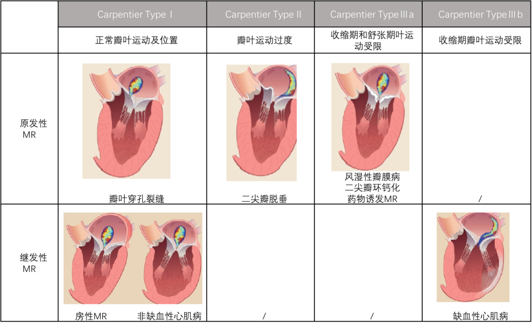 ero为什么不显示经导管二尖瓣修复术：相关病理生理学、研究和治疗综述_https://www.jmylbn.com_新闻资讯_第2张