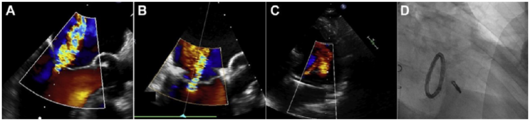 ero为什么不显示经导管二尖瓣修复术：相关病理生理学、研究和治疗综述_https://www.jmylbn.com_新闻资讯_第9张