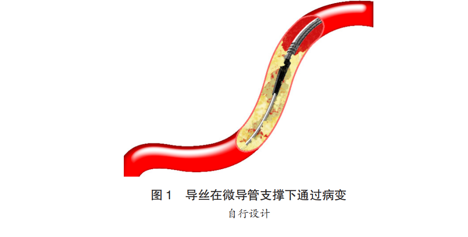 为什么要用到微导管微导管_https://www.jmylbn.com_新闻资讯_第1张