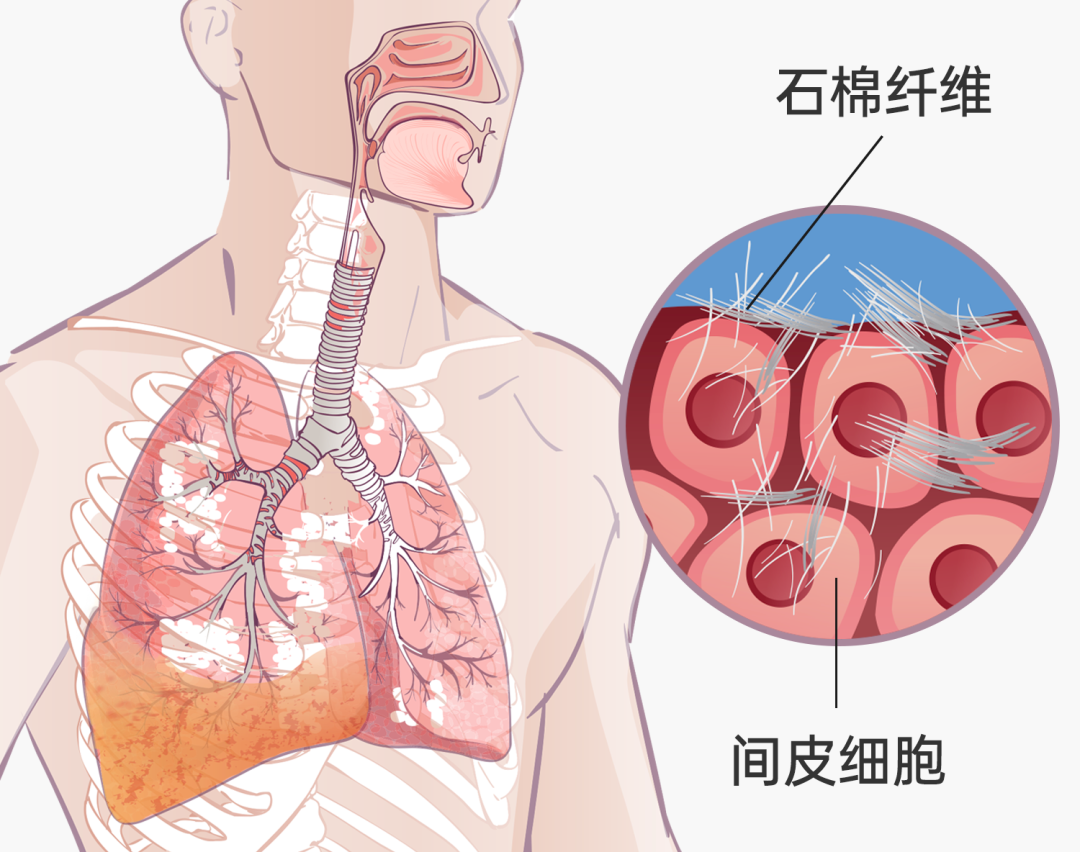可愈有道_74岁确诊晚期间皮瘤患者，古稀老人的临床试验之旅