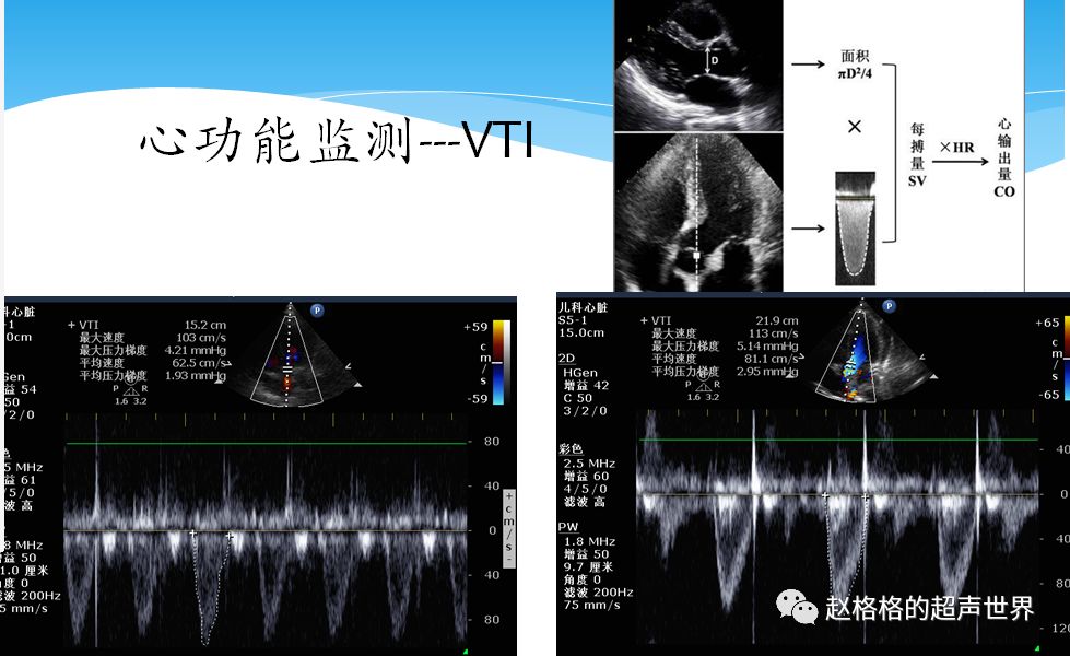 此外,心脏收缩功能还有很多高端方法,比如利用三维超声心动图测量