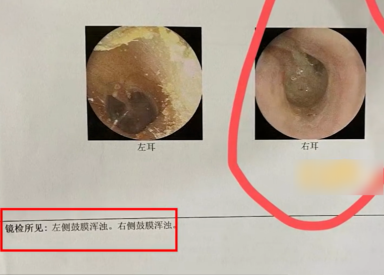 老人误将502胶水滴满耳道