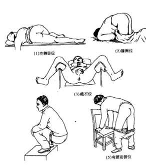 检查指套是什么东西肛门指检　一指便知_https://www.jmylbn.com_新闻资讯_第5张
