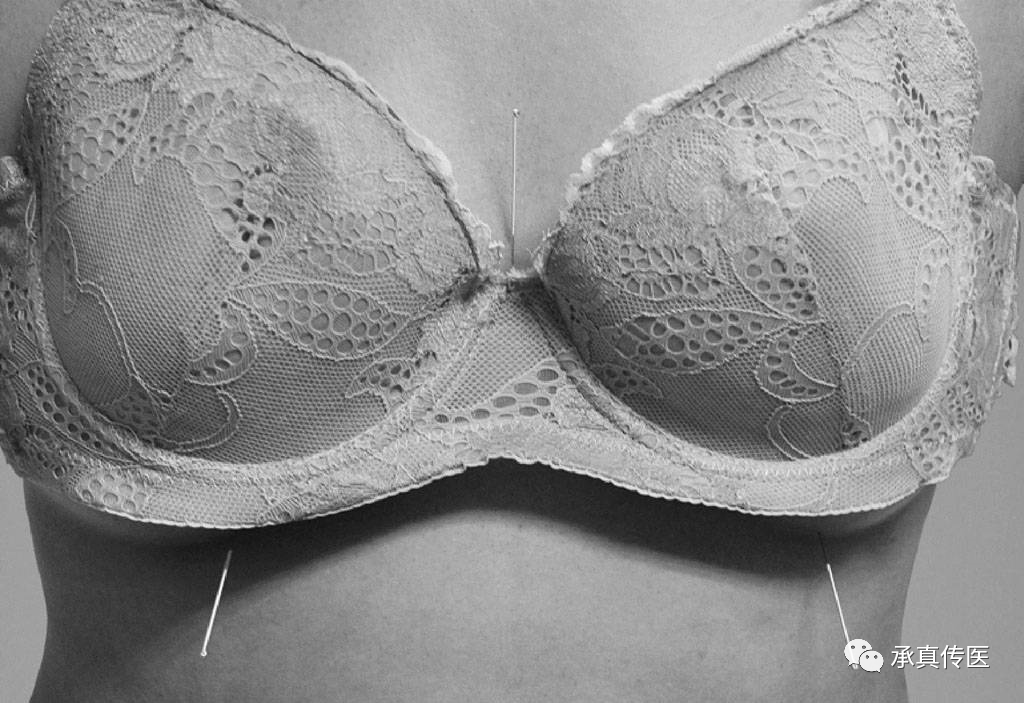 为什么要定位针 乳腺靳三针之乳三针，专治乳腺病。_https://www.jmylbn.com_新闻资讯_第6张