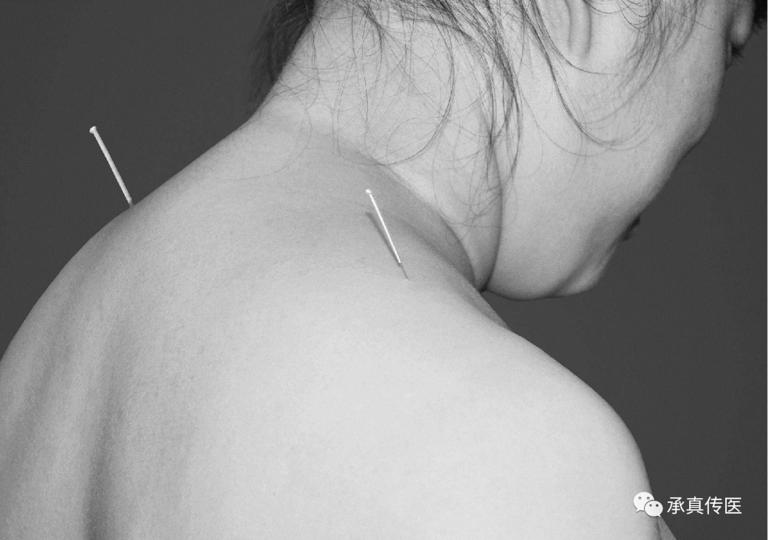 为什么要定位针 乳腺靳三针之乳三针，专治乳腺病。_https://www.jmylbn.com_新闻资讯_第5张