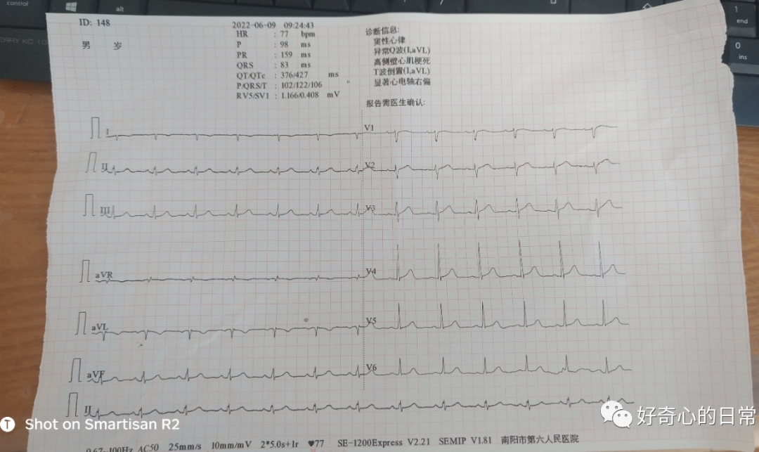 心电图怎么切换导联临床找茬系列｜错接心电图表现_https://www.jmylbn.com_新闻资讯_第3张