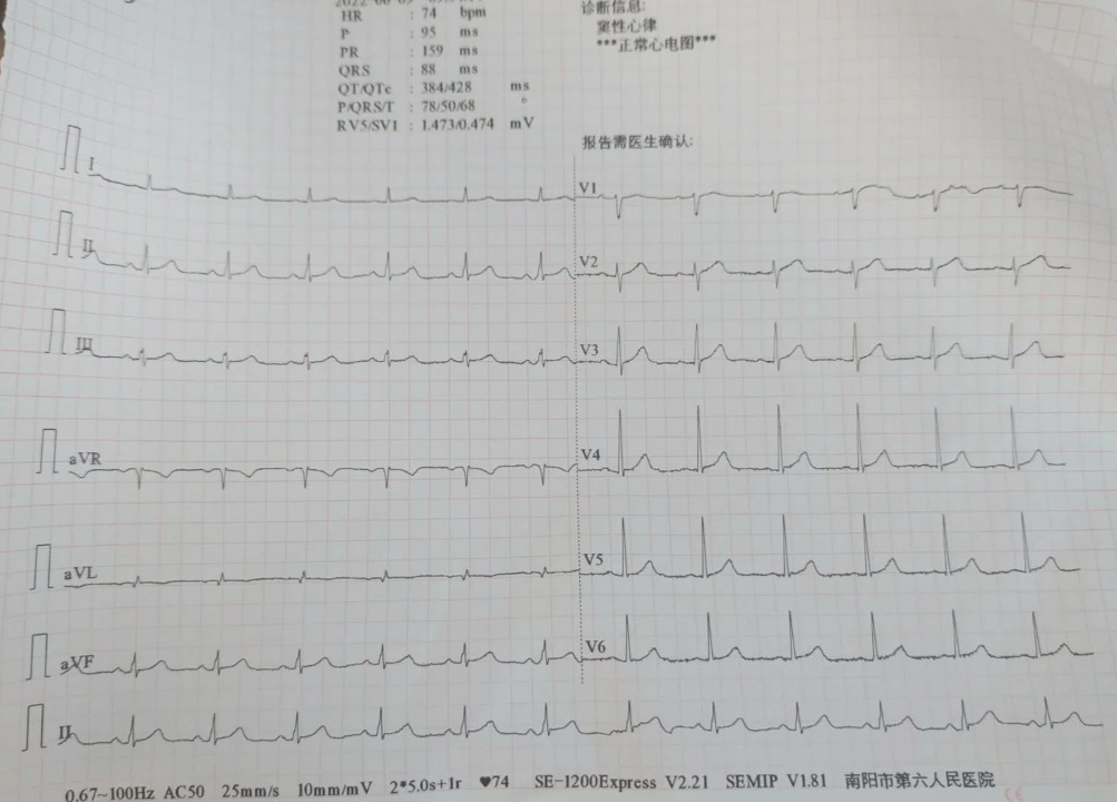 心电图怎么切换导联临床找茬系列｜错接心电图表现_https://www.jmylbn.com_新闻资讯_第4张