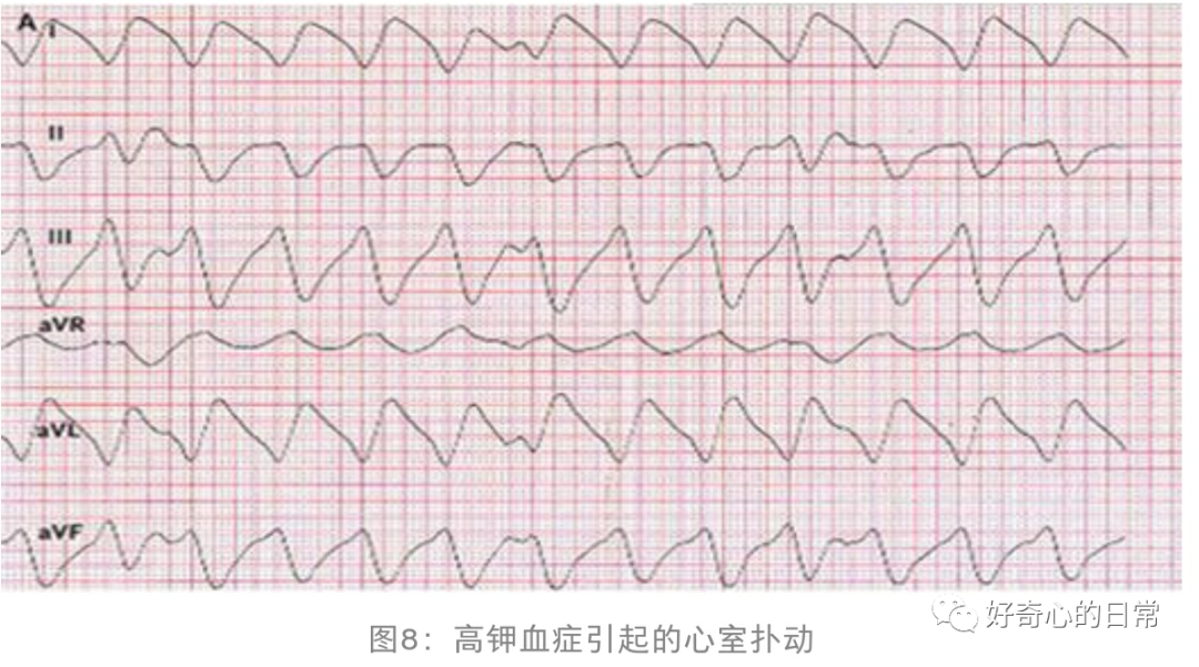 为什么要用推注泵临床基础知识系列（1）-高钾血症的碎碎念_https://www.jmylbn.com_新闻资讯_第7张