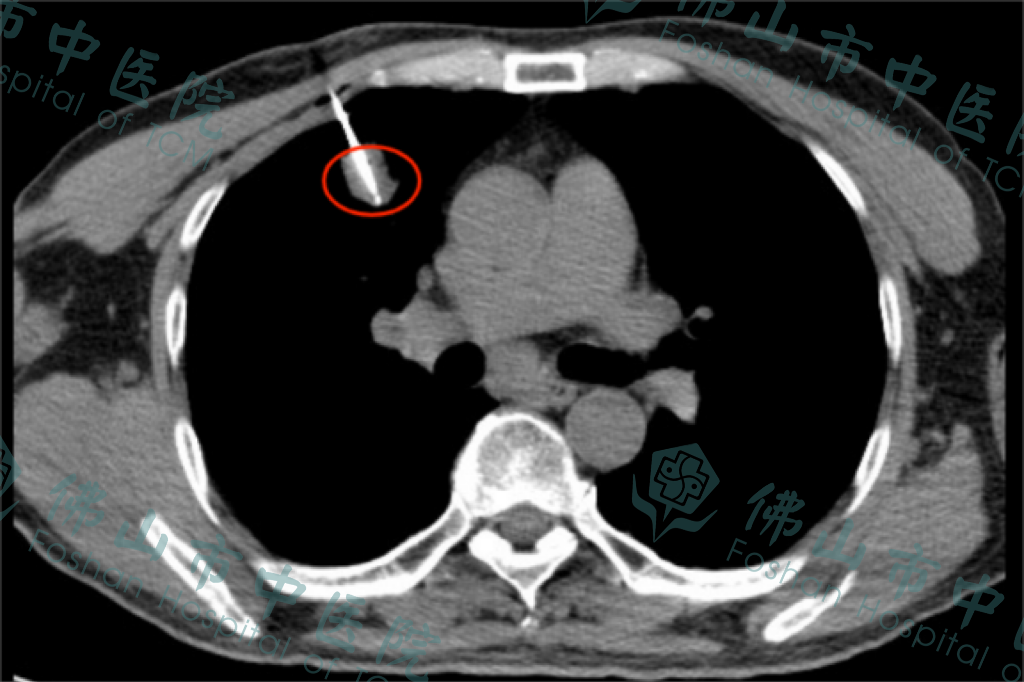 CT显示消融针精准进入肿瘤区域