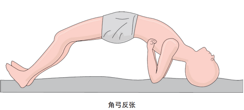 (3)背,腹肌同时收缩,躯干因而扭曲成弓,形成"角弓反张"或"侧弓反张".