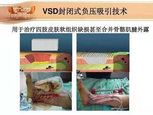 怎么促进vsd伤口愈合VSD负压引流技术    让患者创面更快痊愈_https://www.jmylbn.com_新闻资讯_第3张