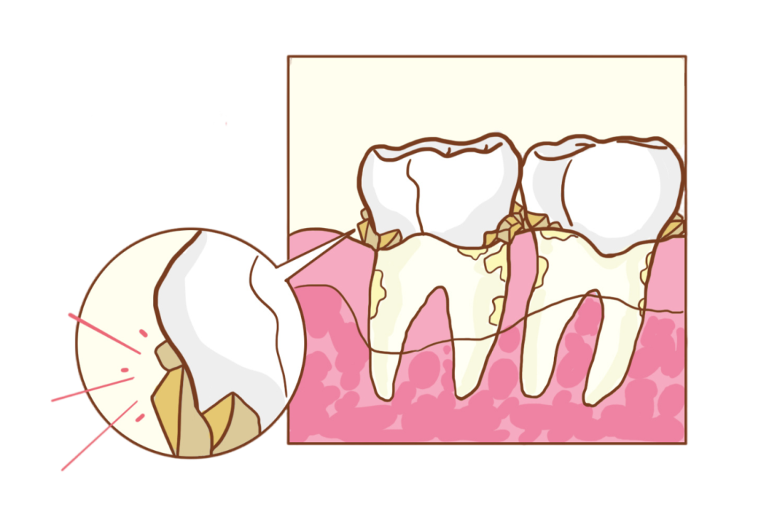 "洗牙会把牙齿洗松,我害怕""洗完牙齿会变薄,敏感""我天天都有刷牙啊"