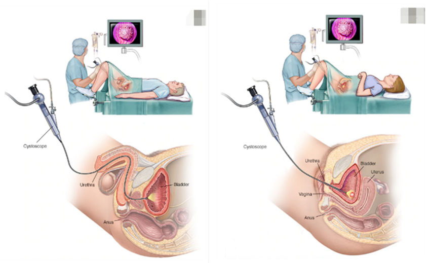 b膀胱镜为什么消毒【科普】膀胱镜检查你了解吗？_https://www.jmylbn.com_新闻资讯_第3张