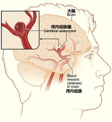 三氧疗法怎么代理预防脑出血@试试三氧自体血免疫疗法！_https://www.jmylbn.com_新闻资讯_第2张