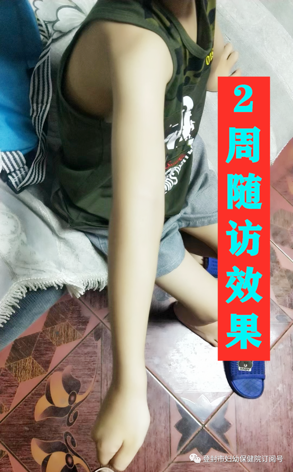 肘关节康复器怎么用【康复小课堂 30 】肘关节骨折术后康复_https://www.jmylbn.com_新闻资讯_第13张