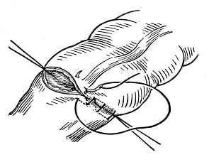 医疗缝线怎么做外科常见缝合方法_https://www.jmylbn.com_新闻资讯_第10张
