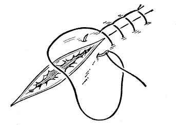 医疗缝线怎么做外科常见缝合方法_https://www.jmylbn.com_新闻资讯_第5张