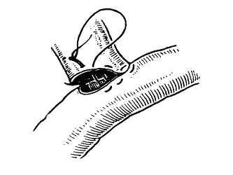 医疗缝线怎么做外科常见缝合方法_https://www.jmylbn.com_新闻资讯_第15张