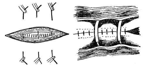 医疗缝线怎么做外科常见缝合方法_https://www.jmylbn.com_新闻资讯_第16张