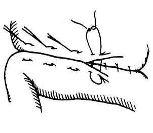 医疗缝线怎么做外科常见缝合方法_https://www.jmylbn.com_新闻资讯_第8张