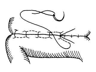 医疗缝线怎么做外科常见缝合方法_https://www.jmylbn.com_新闻资讯_第9张