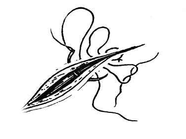 医疗缝线怎么做外科常见缝合方法_https://www.jmylbn.com_新闻资讯_第14张