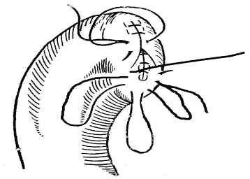 医疗缝线怎么做外科常见缝合方法_https://www.jmylbn.com_新闻资讯_第12张