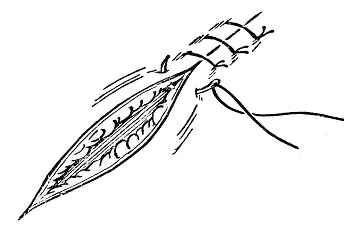 医疗缝线怎么做外科常见缝合方法_https://www.jmylbn.com_新闻资讯_第3张