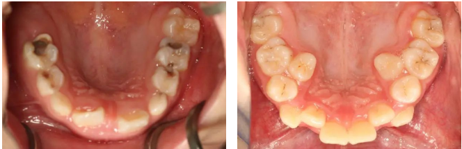 医用钳子怎么拿钳子拔牙、乳牙龋齿……医生：别拿乳牙不当牙，这份护牙“秘笈”请收好~_https://www.jmylbn.com_新闻资讯_第41张