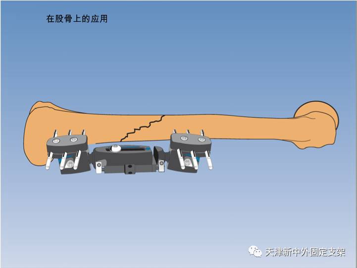 下肢全透光型外固定支架的應用