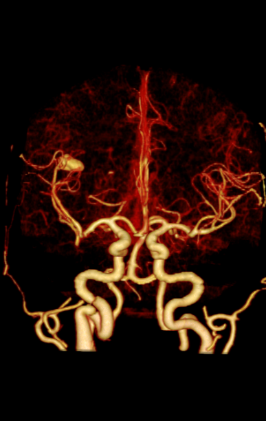 联影ct怎么样科技助力健康丨“全球顶尖超高端”联影天河640层CT启用“满百天”_https://www.jmylbn.com_新闻资讯_第10张