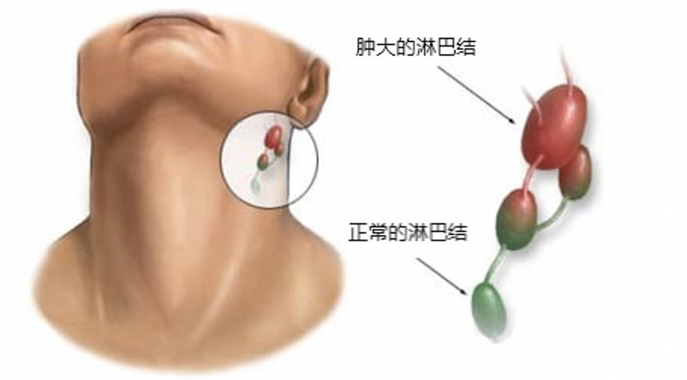 通常普通细菌感染治疗后见效快;淋巴结核治疗周期长,但总体预后较好.