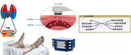 什么是经皮氧分压【医讲堂】糖尿病足防治利器——经皮氧分压检测_https://www.jmylbn.com_新闻资讯_第8张