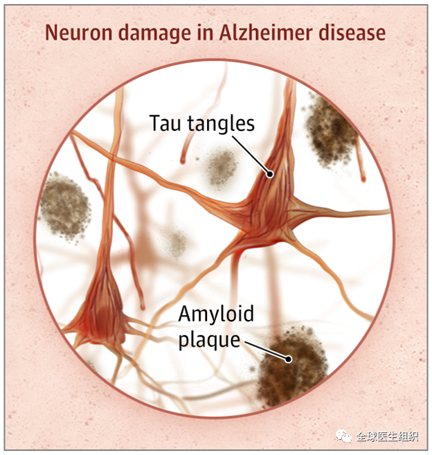 |必讀|新冠病毒感染影響大腦, 增加患癡呆症幾率嗎？ 健康 第1張