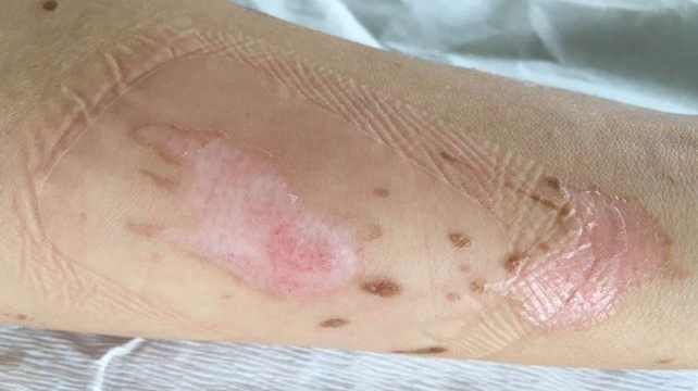 人工敷料怎么照顾伤口湿性愈合&新型敷料：伤口护理好帮手（上）_https://www.jmylbn.com_新闻资讯_第5张