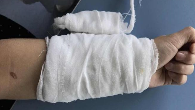 人工敷料怎么照顾伤口湿性愈合&新型敷料：伤口护理好帮手（上）_https://www.jmylbn.com_新闻资讯_第3张