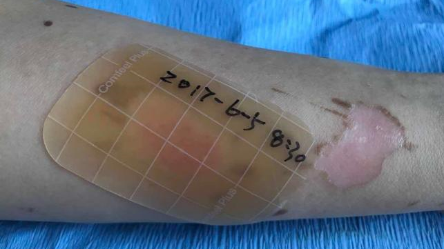 人工敷料怎么照顾伤口湿性愈合&新型敷料：伤口护理好帮手（上）_https://www.jmylbn.com_新闻资讯_第4张