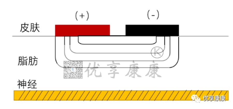 理疗电极贴片怎么用康复治疗师怎样正确使用中频电极片？_https://www.jmylbn.com_新闻资讯_第7张