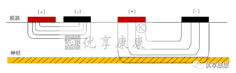 理疗电极贴片怎么用康复治疗师怎样正确使用中频电极片？_https://www.jmylbn.com_新闻资讯_第6张