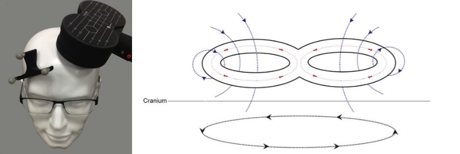 tms什么医疗神经调控——TMS技术，你get到了吗_https://www.jmylbn.com_新闻资讯_第5张
