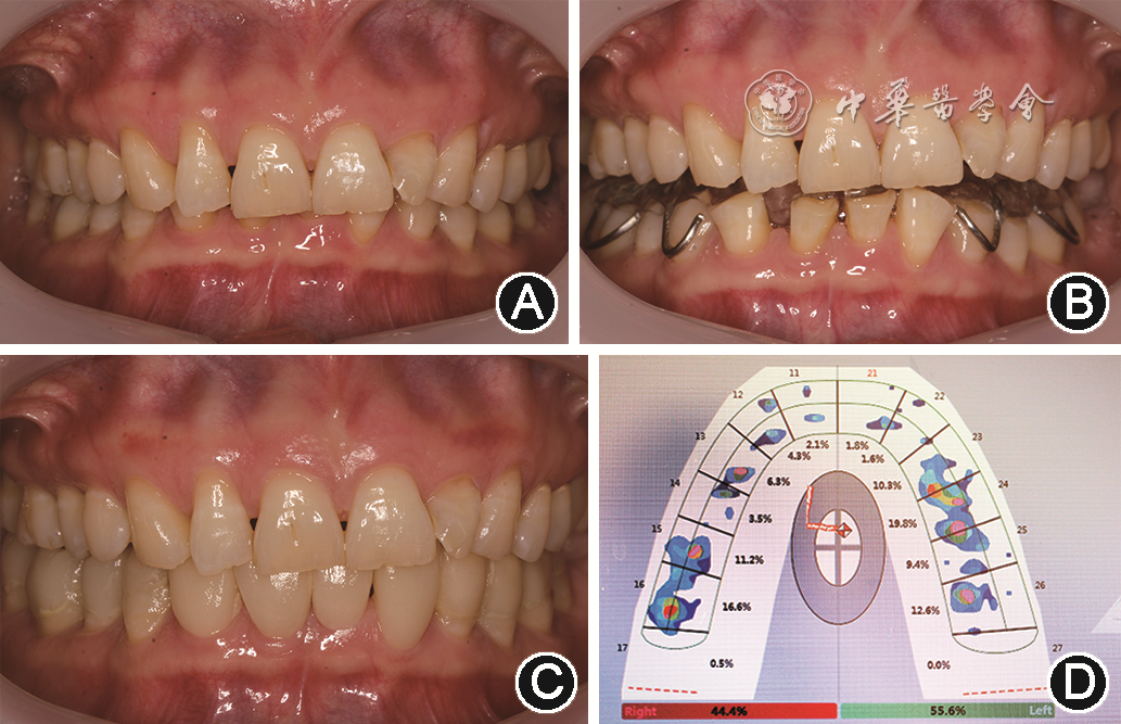 mmd在医学上什么意思【专家笔谈】咀嚼肌功能紊乱和修复专科处理_https://www.jmylbn.com_新闻资讯_第5张