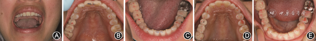 mmd在医学上什么意思【专家笔谈】咀嚼肌功能紊乱和修复专科处理_https://www.jmylbn.com_新闻资讯_第2张